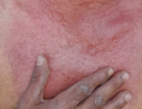 Afectaci&oacute;n en la piel de un trabajador de una plantaci&oacute;n bananera.